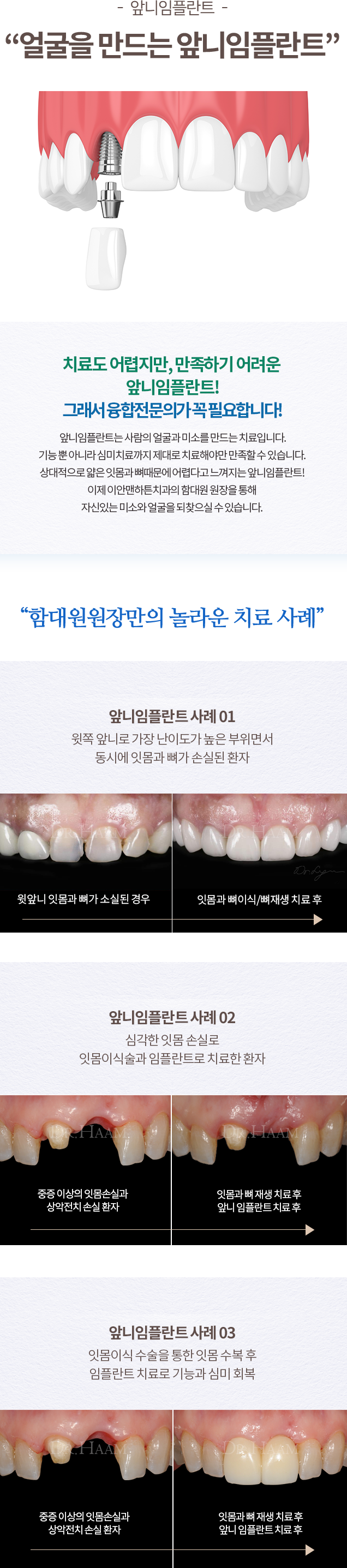임플란트