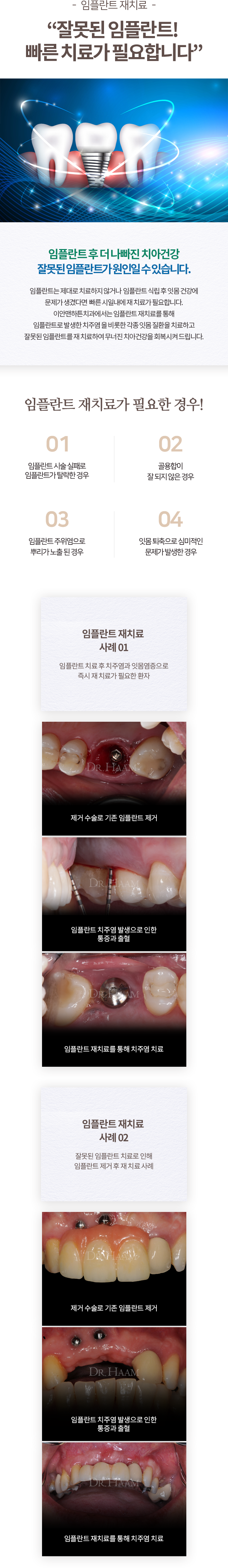 임플란트