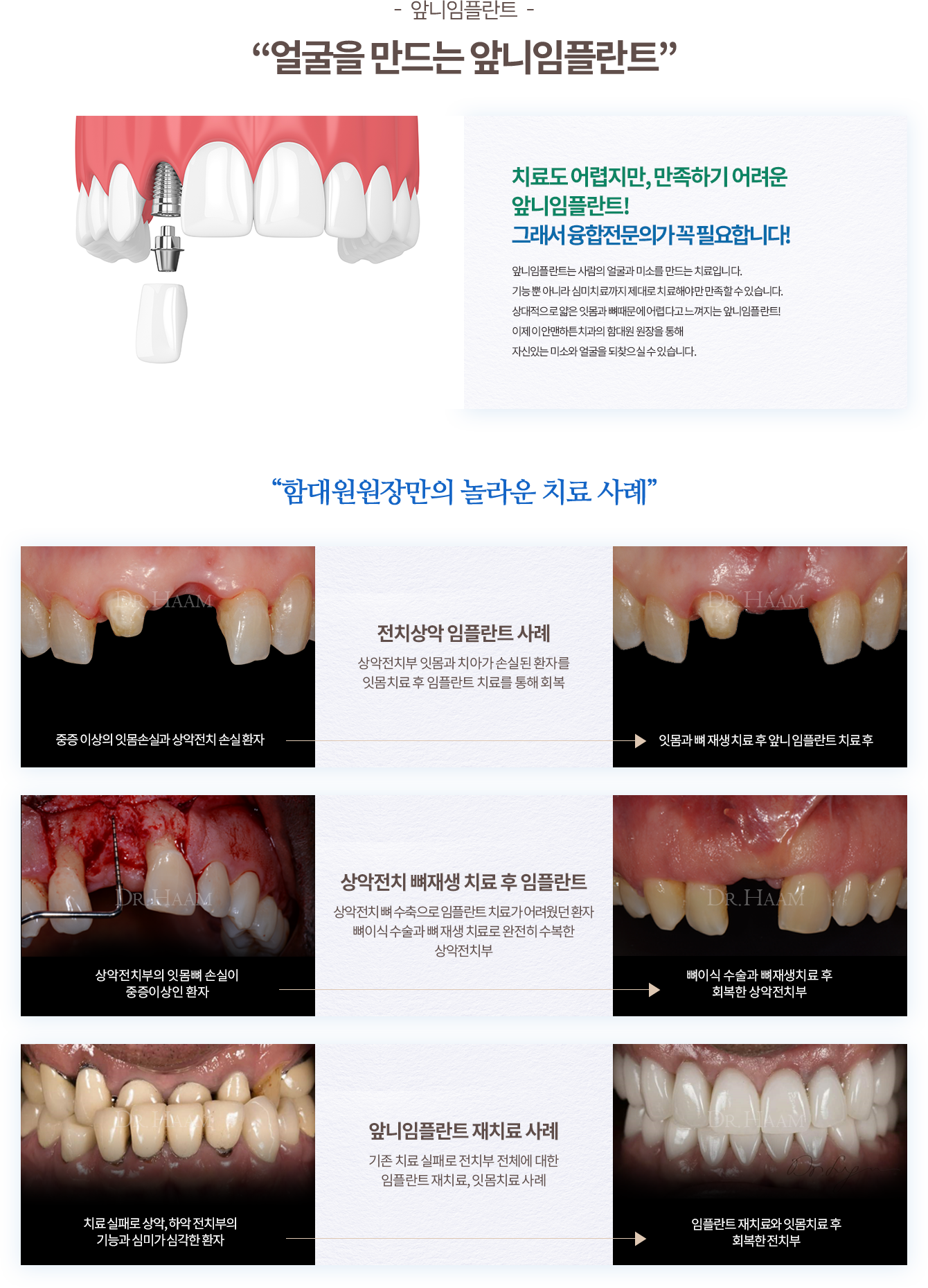 임플란트