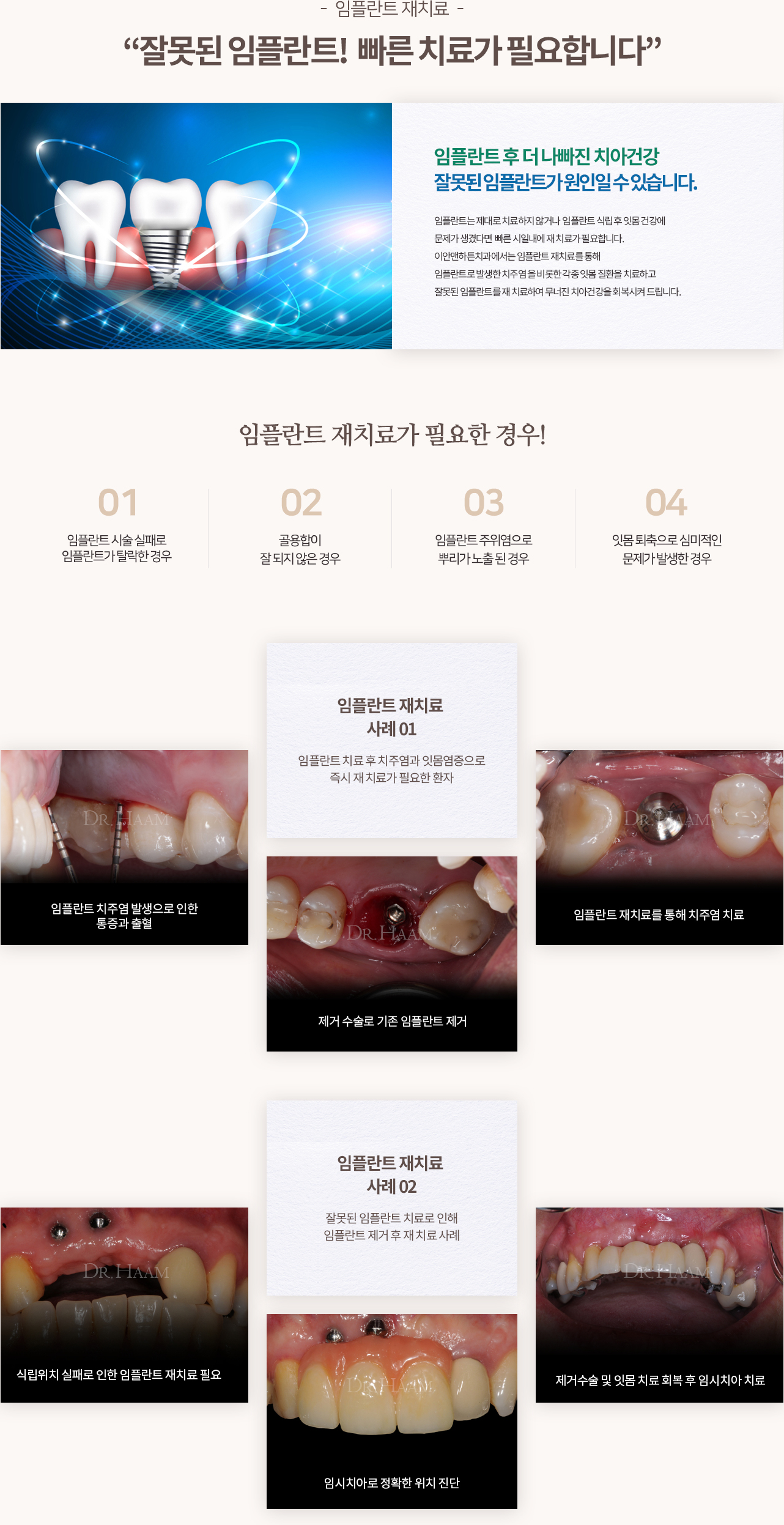 임플란트